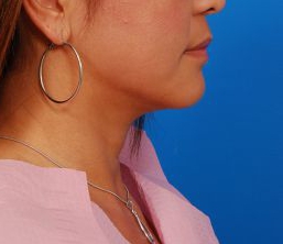 Woman's face, after Submental Lipocontouring treatment, r-side view, patient 7