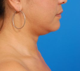 Woman's face, before Submental Lipocontouring treatment, r-side view, patient 7