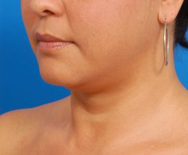 Woman's face, before Submental Lipocontouring treatment, l-side oblique view, patient 7