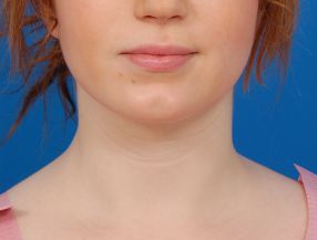 Woman's face, after Submental Lipocontouring treatment, front view, patient 8