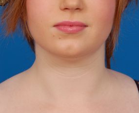 Woman's face, before Submental Lipocontouring treatment, front view, patient 8