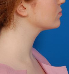 Woman's face, after Submental Lipocontouring treatment, r-side view, patient 8
