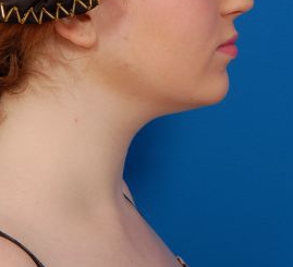 Woman's face, before Submental Lipocontouring treatment, r-side view, patient 8