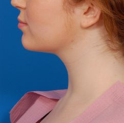 Woman's face, after Submental Lipocontouring treatment, l-side view, patient 8