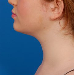 Woman's face, before Submental Lipocontouring treatment, l-side view, patient 8