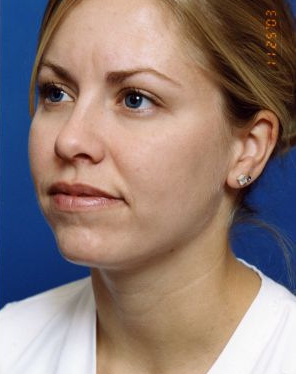 Woman's face, after Submental Lipocontouring treatment, l-side oblique view, patient 9