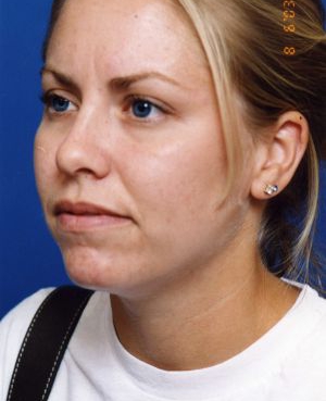 Woman's face, before Submental Lipocontouring treatment, l-side oblique view, patient 9