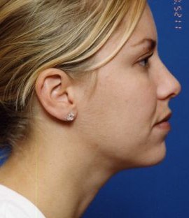 Woman's face, after Submental Lipocontouring treatment, r-side view, patient 9