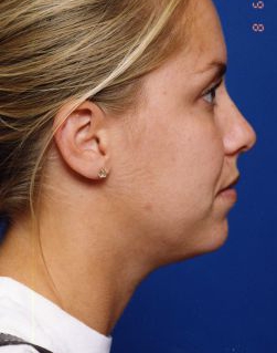 Woman's face, before Submental Lipocontouring treatment, r-side view, patient 9