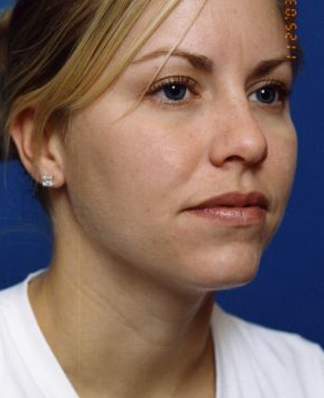 Woman's face, after Submental Lipocontouring treatment, r-side oblique view, patient 9
