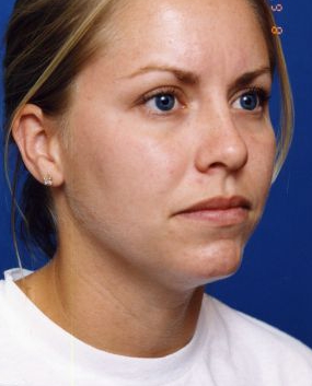 Woman's face, before Submental Lipocontouring treatment, r-side oblique view, patient 9