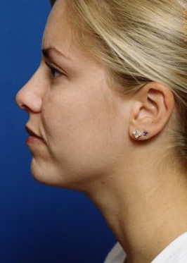 Woman's face, after Submental Lipocontouring treatment, l-side view, patient 9