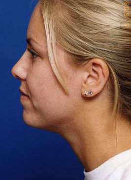 Woman's face, before Submental Lipocontouring treatment, l-side view, patient 9