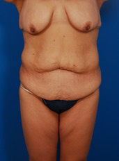 Woman's body, before Thigh Lift treatment, front view, patient 1