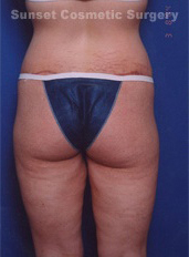 Woman's legs, after Thigh Lift treatment, back side view, patient 2