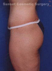 Woman's legs, after Thigh Lift treatment, l-side view, patient 2