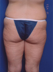 Woman's legs, before Thigh Lift treatment, back side view, patient 2