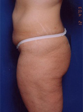 Woman's legs, before Thigh Lift treatment, l-side view, patient 2