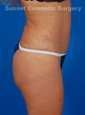 Woman's body, after Tummy Tuck treatment, r-side view, patient 1
