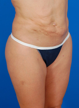 Woman's body, before Tummy Tuck treatment, r-side oblique view, patient 1