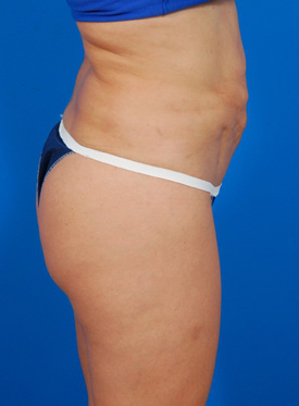 Woman's body, before Tummy Tuck treatment, r-side view, patient 1