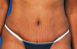 Woman's body, after Tummy Tuck treatment, front view, patient 10