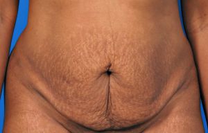 Woman's body, before Tummy Tuck treatment, front view, patient 10