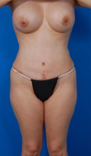 Woman's body, after Tummy Tuck treatment, front view, patient 12