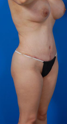 Woman's body, after Tummy Tuck treatment, r-side oblique view, patient 12