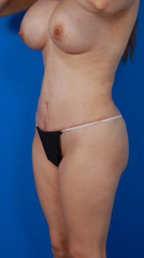 Woman's body, after Tummy Tuck treatment, l-side oblique view, patient 12