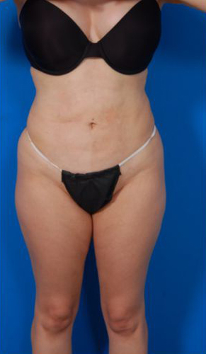 Woman's body, before Tummy Tuck treatment, front view, patient 12