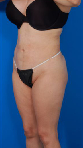 Woman's body, before Tummy Tuck treatment, l-side oblique view, patient 12