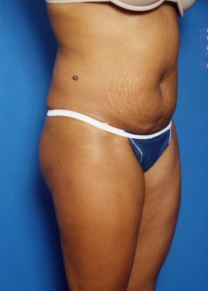 Woman's body, before Tummy Tuck treatment, r-side oblique view, patient 16