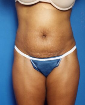 Woman's body, before Tummy Tuck treatment, front view, patient 16