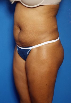 Woman's body, before Tummy Tuck treatment, l-side oblique view, patient 16