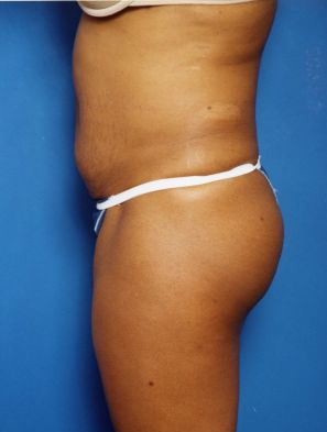 Woman's body, before Tummy Tuck treatment, l-side view, patient 16