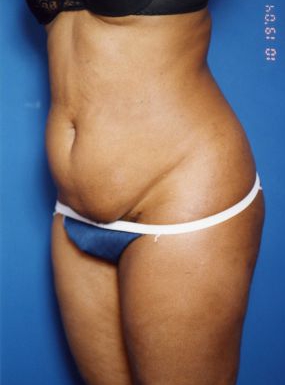 Woman's body, before Tummy Tuck treatment, l-side oblique view, patient 13