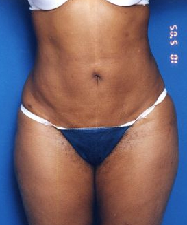 Woman's body, after Tummy Tuck treatment, front view, patient 13