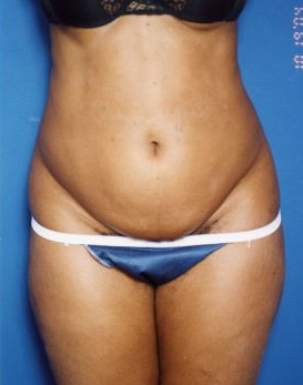 Woman's body, before Tummy Tuck treatment, front view, patient 13