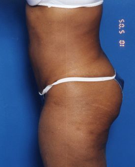 Woman's body, after Tummy Tuck treatment, l-side view, patient 13