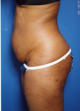 Woman's body, before Tummy Tuck treatment, l-side view, patient 13