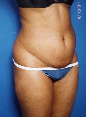 Woman's body, before Tummy Tuck treatment, r-side oblique view, patient 13