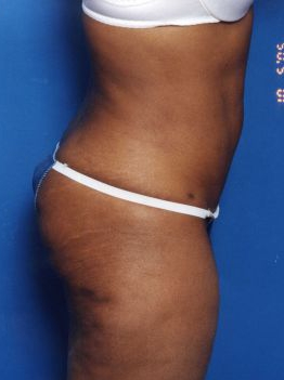 Woman's body, after Tummy Tuck treatment, r-side view, patient 13