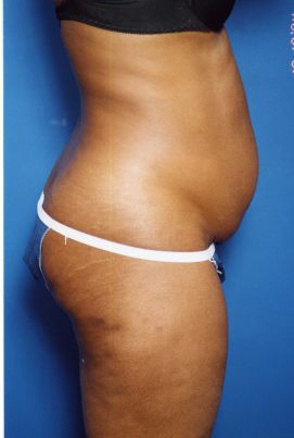 Woman's body, before Tummy Tuck treatment, r-side view, patient 13