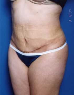 Woman's body, after Tummy Tuck treatment, l-side oblique view, patient 14