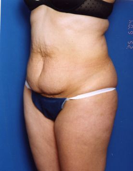 Woman's body, before Tummy Tuck treatment, l-side oblique view, patient 14