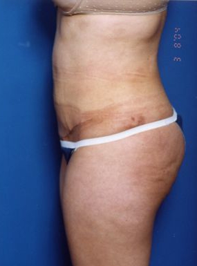 Woman's body, after Tummy Tuck treatment, l-side view, patient 14