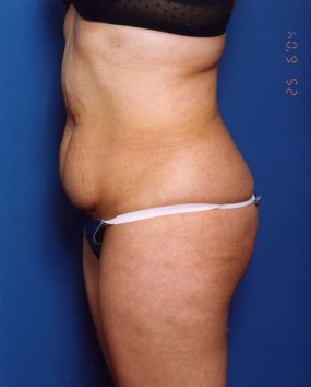 Woman's body, before Tummy Tuck treatment, l-side view, patient 14