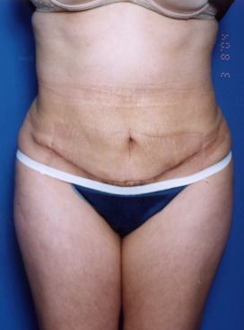 Woman's body, after Tummy Tuck treatment, front view, patient 14