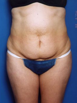 Woman's body, before Tummy Tuck treatment, front view, patient 14